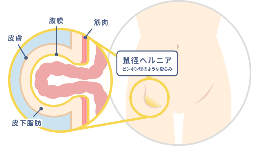 鼠径ヘルニアとは