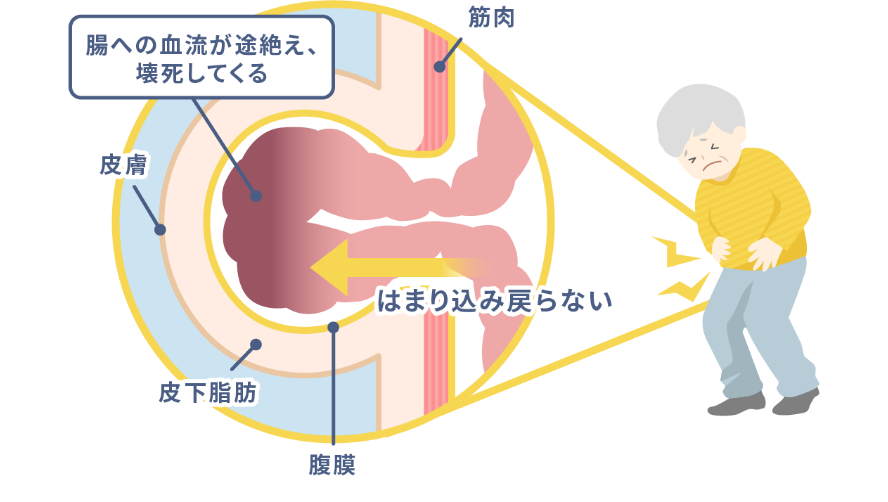 命に危険が及ぶ嵌頓とは